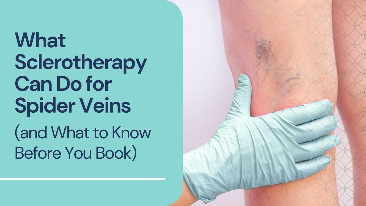 What Sclerotherapy Can Do for Spider Veins (and What to Know Before You Book)